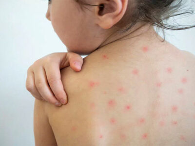 হাম ছড়াচ্ছে ভয়াবহভাবে, টিকাদানের বিরুদ্ধে যারা অপতথ্য ছড়িয়েছে তাদের বিচার হবে?