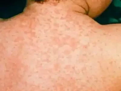 রাজশাহী বিভাগে হাম ছড়াচ্ছে মারাত্মকভাবে