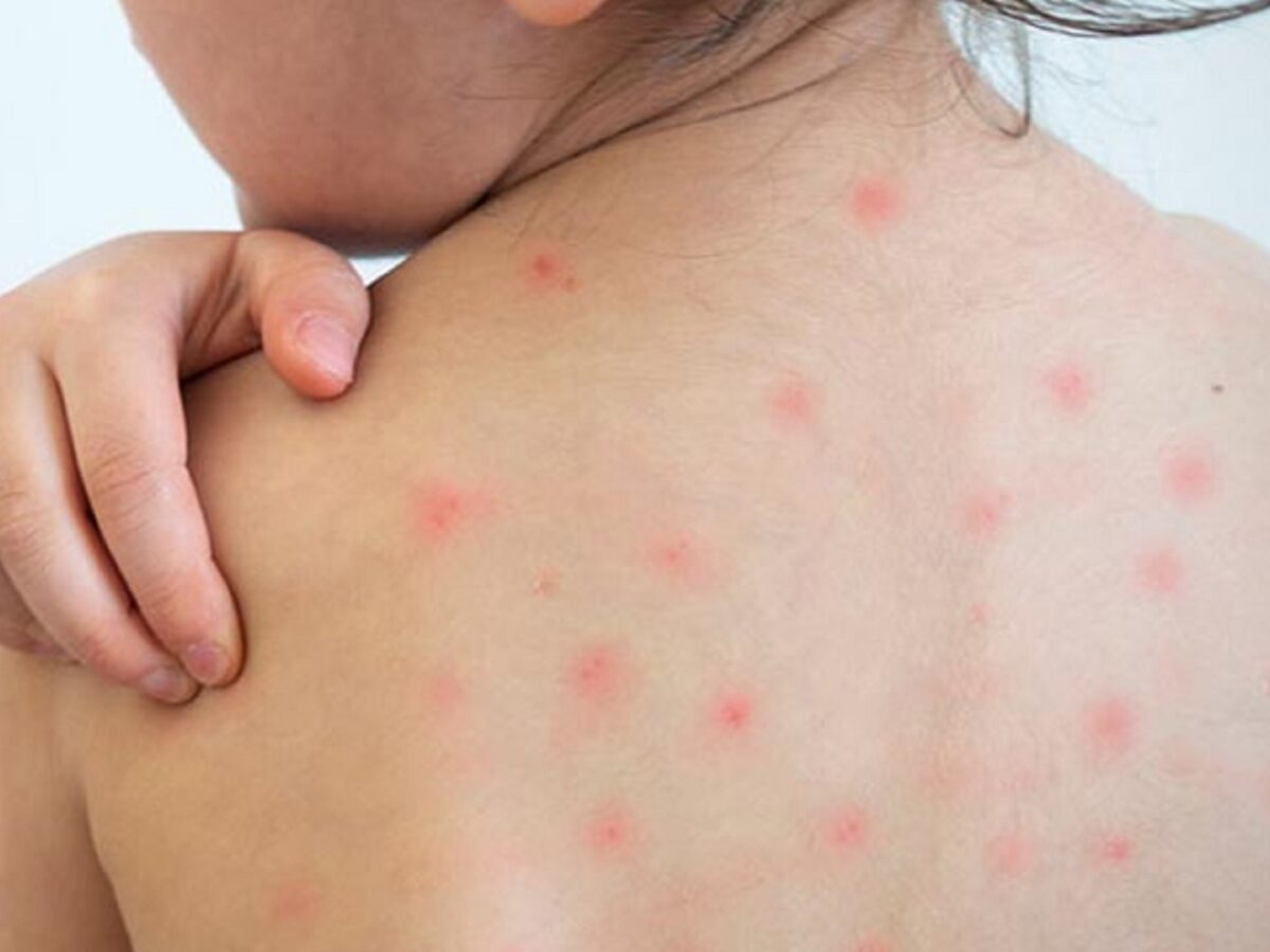 ময়মনসিংহ মেডিকেলে হামের উপসর্গ নিয়ে আরও এক শিশু মারা গিয়েছে