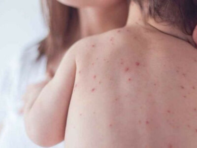 ২৪ ঘণ্টায় হাম আক্রান্ত হয়ে আরও ২ শিশুর মৃত্যু