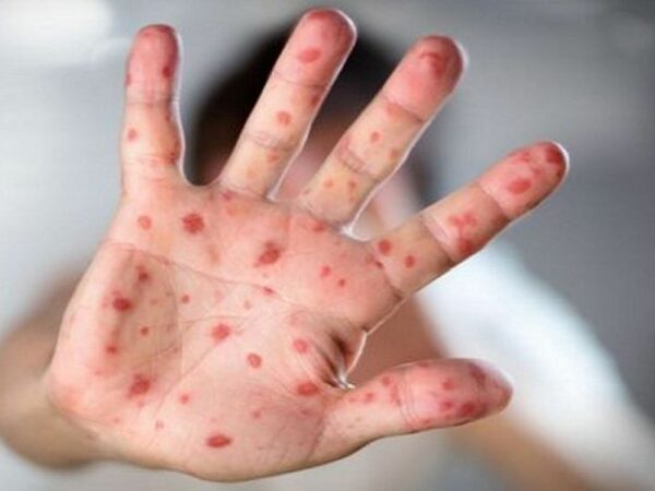 চট্টগ্রামে শিশুদের হাম-পরবর্তী নিউমোনিয়া বাড়ছে