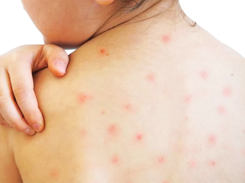 মর্মান্তিক! হাম ও হামের উপসর্গ নিয়ে আরও ৮ জনের মৃত্যু