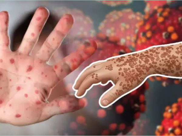 হামে আরও ১ শিশুর মৃত্যু, আক্রান্ত হাজারের বেশি