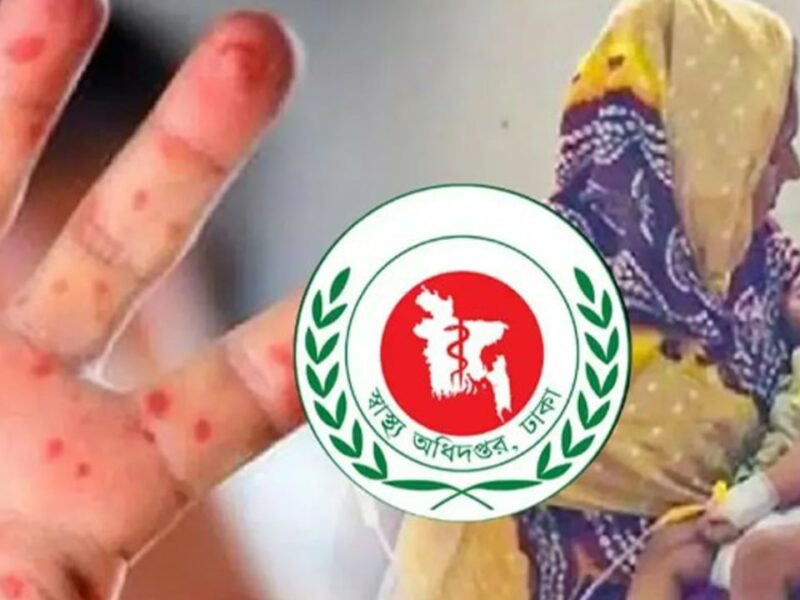 হাম ও উপসর্গে মৃত্যু বেড়ে ৬৭০