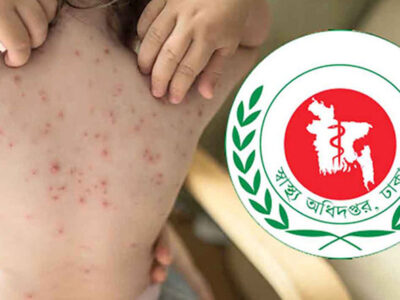 হাম উপসর্গে আরও দুই শিশুর মৃত্যু