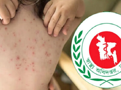 গত একদিনে হামে আরও পাঁচ জনের মৃত্যু