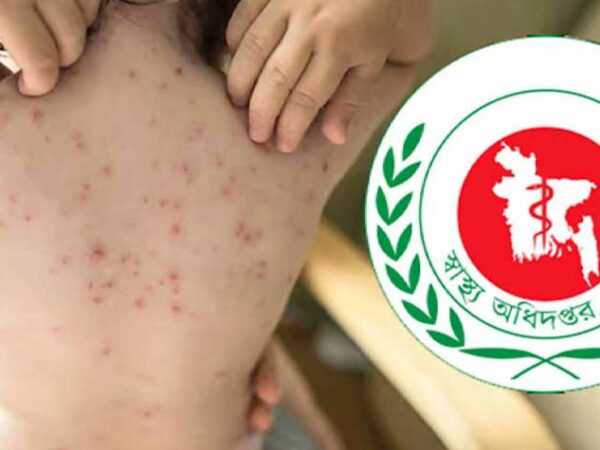 হামের উপসর্গে আরও ৮ শিশুর মৃত্যু, মোট ১০৩০