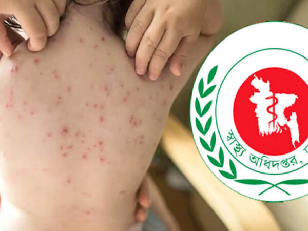 হাম উপসর্গে আরও ৩ মৃত্যু