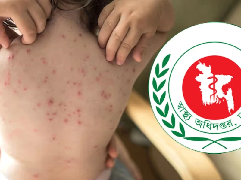 হাম উপসর্গে আরও ৮ শিশুর মৃত্যু, আক্রান্ত ১৩২০